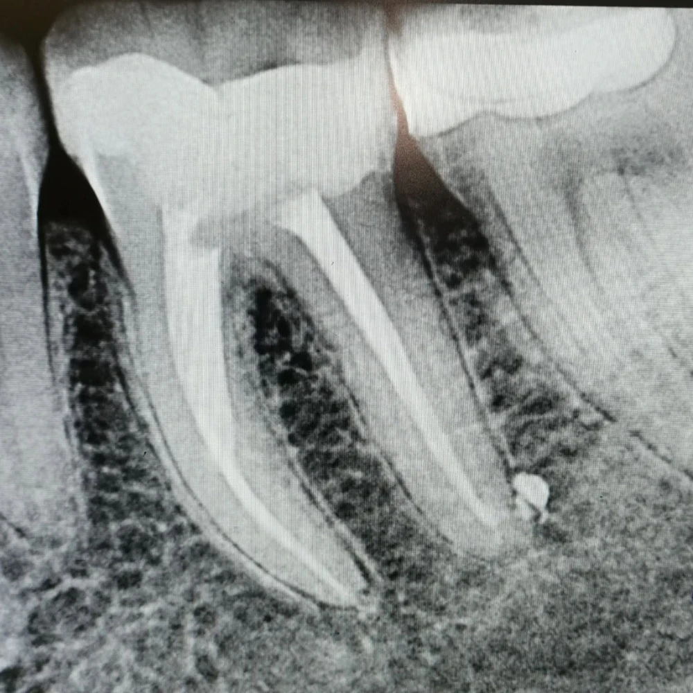 🦷 چارەسەری ڕەگی ددان